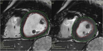 Timely Pulmonary Valve Replacement May Allow Preservation of Left Ventricular Circumferential Strain in Patients with Tetralogy of Fallot